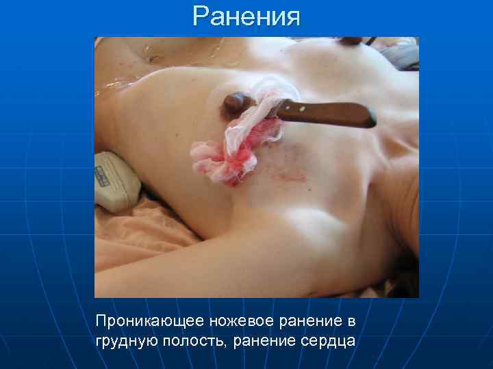 Ранения Проникающее ножевое ранение в грудную полость, ранение сердца 