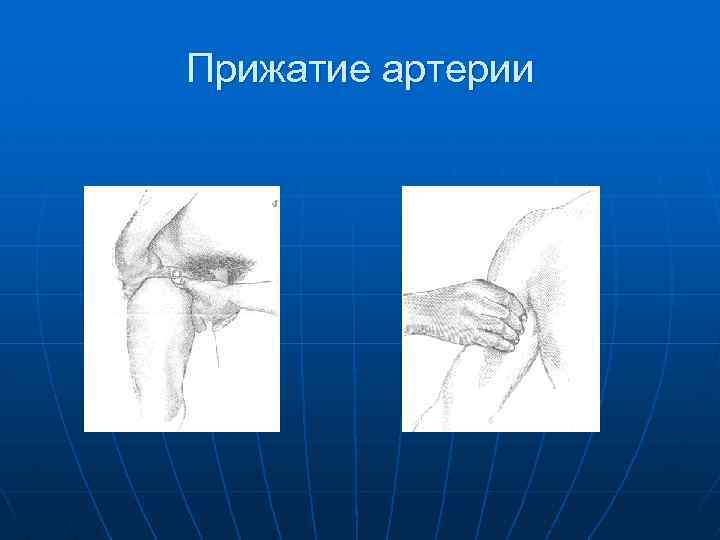 Прижатие артерии 