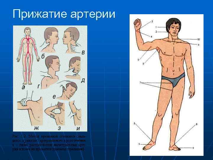 Прижатие артерии 