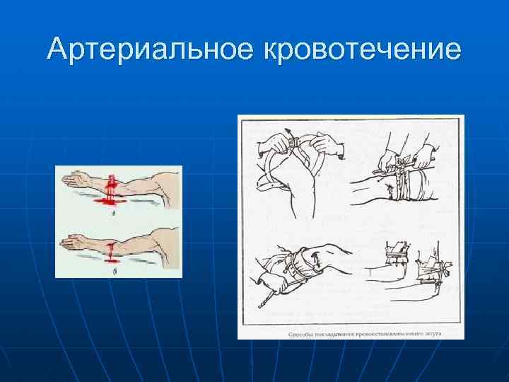 Артериальное кровотечение 