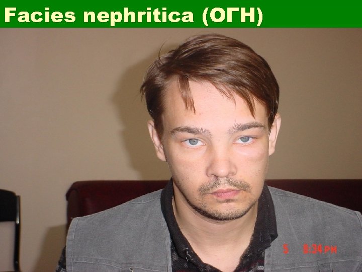 Facies nephritica (ОГН) 