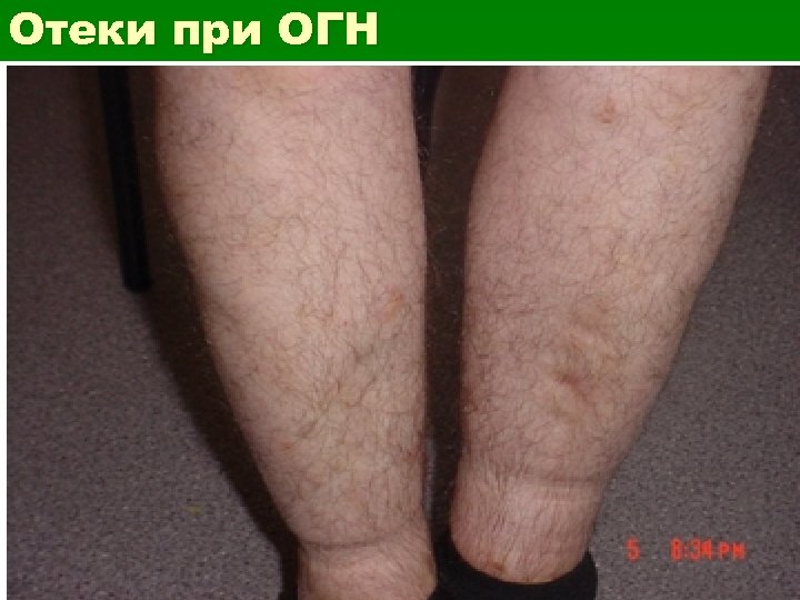 Отеки при ОГН 