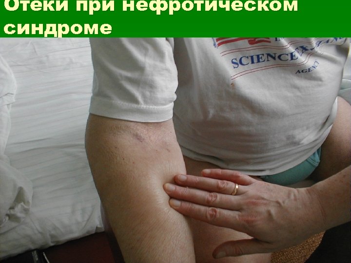 Отеки при нефротическом синдроме 