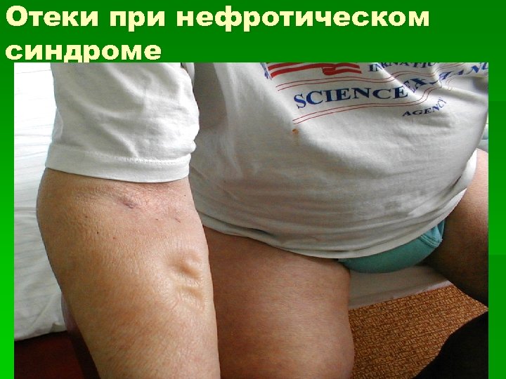 Отеки при нефротическом синдроме 