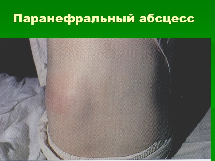 Паранефральный абсцесс 