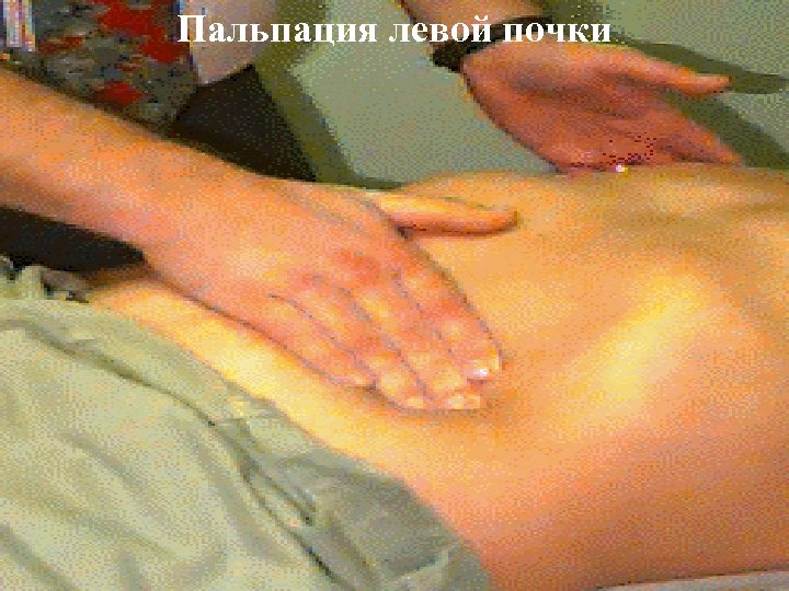 Пальпация левой почки 