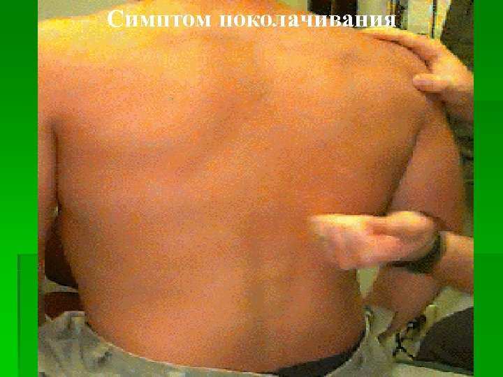 Симптом поколачивания 