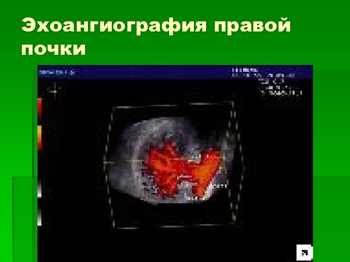 Эхоангиография правой почки 