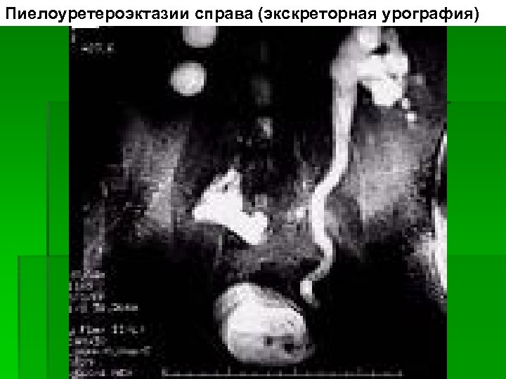 Пиелоуретероэктазии справа (экскреторная урография) 