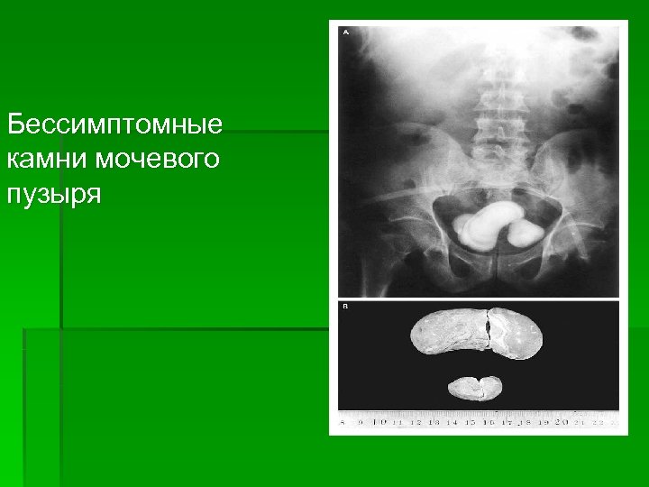 Бессимптомные камни мочевого пузыря 
