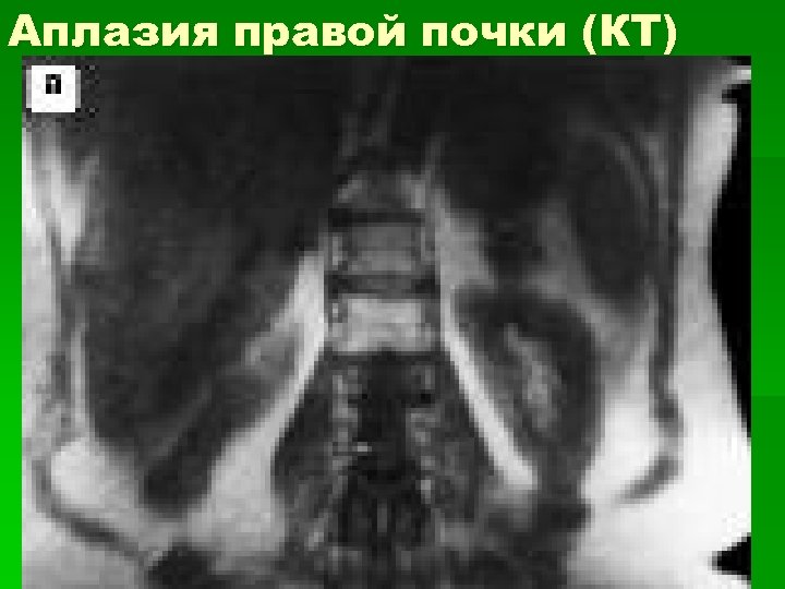 Аплазия правой почки (КТ) 