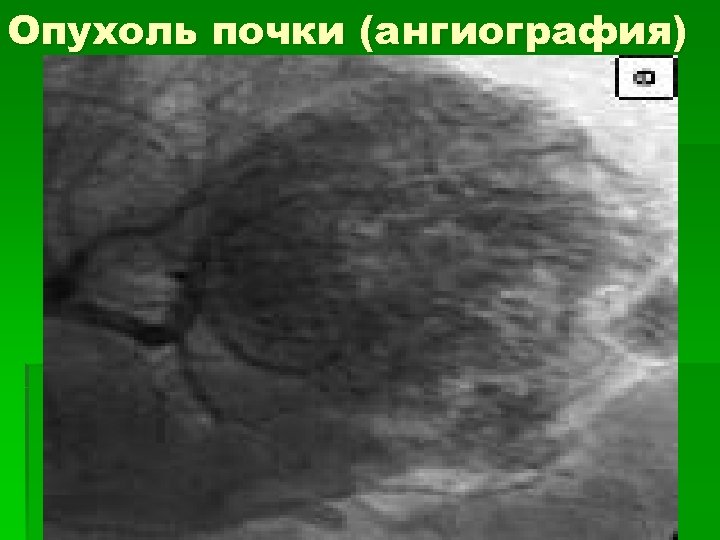 Опухоль почки (ангиография) 