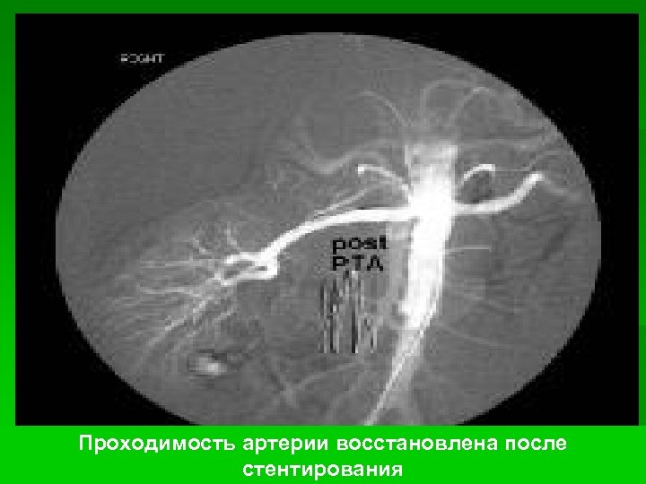 Проходимость артерии восстановлена после стентирования 