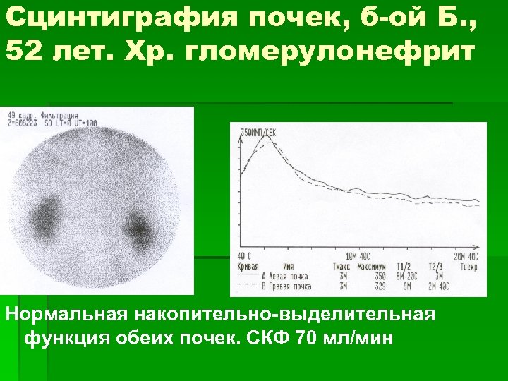 Сцинтиграфия почек, б-ой Б. , 52 лет. Хр. гломерулонефрит Нормальная накопительно-выделительная функция обеих почек.