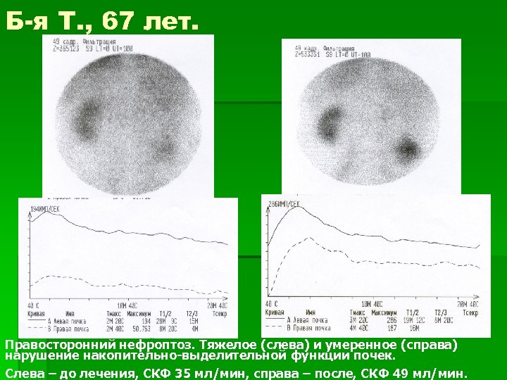 Б-я Т. , 67 лет. Правосторонний нефроптоз. Тяжелое (слева) и умеренное (справа) нарушение накопительно-выделительной
