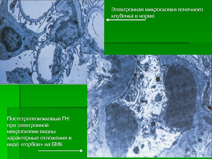 Электронная микроскопия почечного клубочка в норме Постстрептококковый ГН: при электронной микроскопии видны характерные отложения