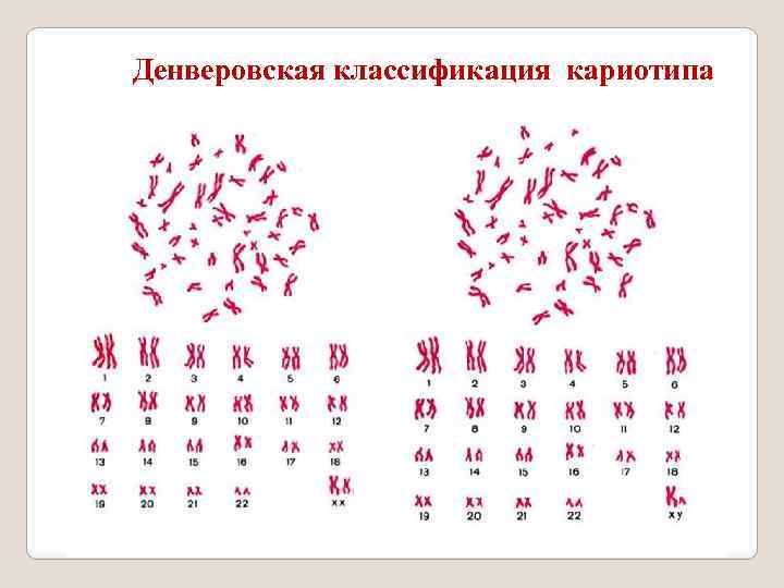 Денверовская классификация кариотипа 