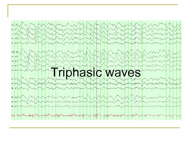 Triphasic waves 