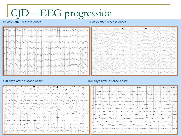 CJD – EEG progression 