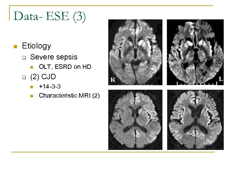 Data- ESE (3) n Etiology q Severe sepsis n q OLT, ESRD on HD