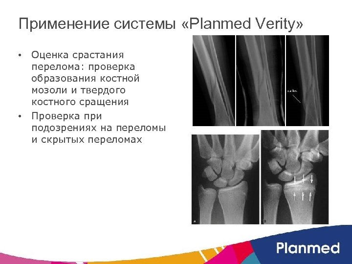 Применение системы «Planmed Verity» • Оценка срастания перелома: проверка образования костной мозоли и твердого