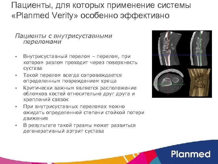 Пациенты, для которых применение системы «Planmed Verity» особенно эффективно Пациенты с внутрисуставными переломами •