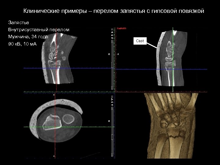 Клинические примеры – перелом запястья с гипсовой повязкой Запястье Внутрисуставный перелом Мужчина, 34 года