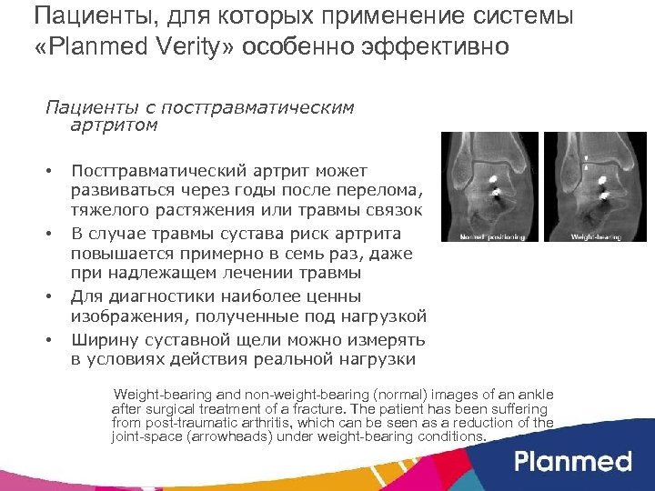 Пациенты, для которых применение системы «Planmed Verity» особенно эффективно Пациенты с посттравматическим артритом •