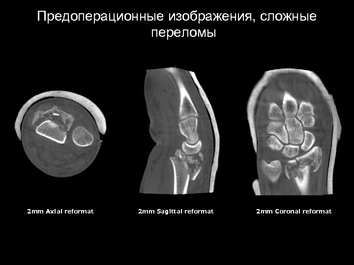 Предоперационные изображения, сложные переломы 2 mm Axial reformat 2 mm Sagittal reformat 2 mm