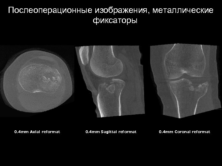 Послеоперационные изображения, металлические фиксаторы 0. 4 mm Axial reformat 0. 4 mm Sagittal reformat