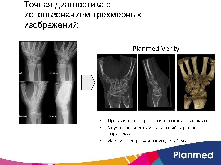 Точная диагностика с использованием трехмерных изображений: Planmed Verity • • • Простая интерпретация сложной