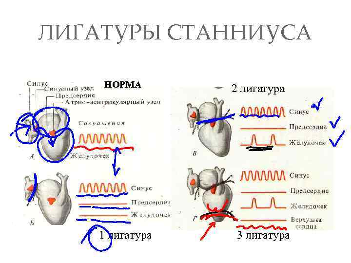 Схема наложения лигатур по станниусу