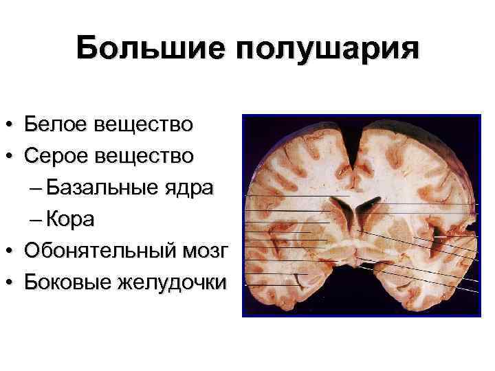 Большие полушария • Белое вещество • Серое вещество – Базальные ядра – Кора •