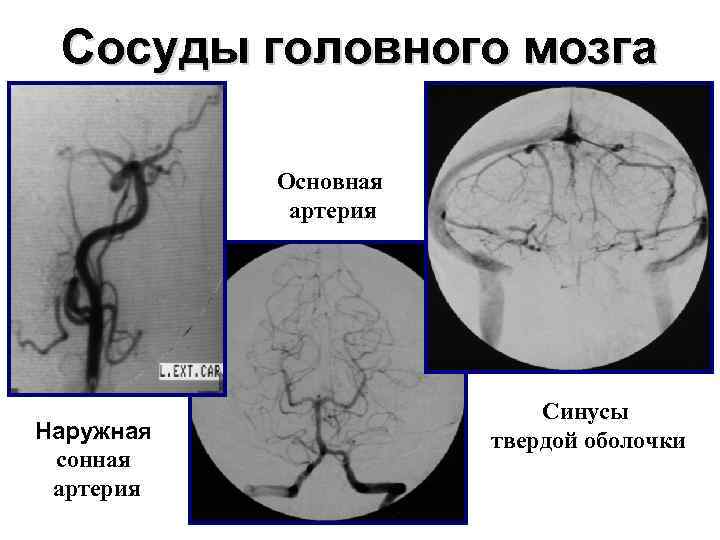 Сонная артерия головного мозга