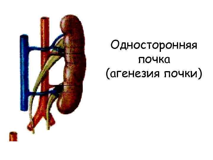 Односторонняя почка (агенезия почки) 