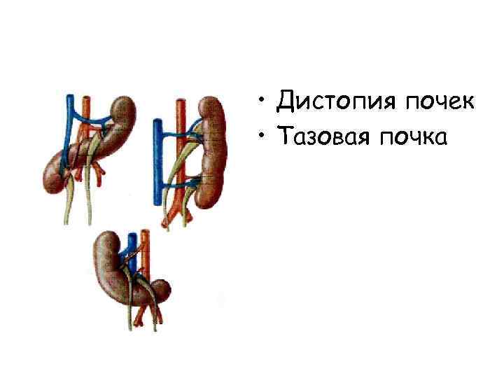 Поясничная дистопия почки. Анатомия почек у детей. Тазовые почки. Дистопия левой почки