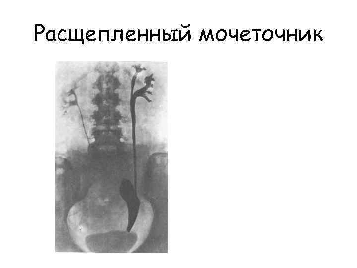 Расщепленный мочеточник 