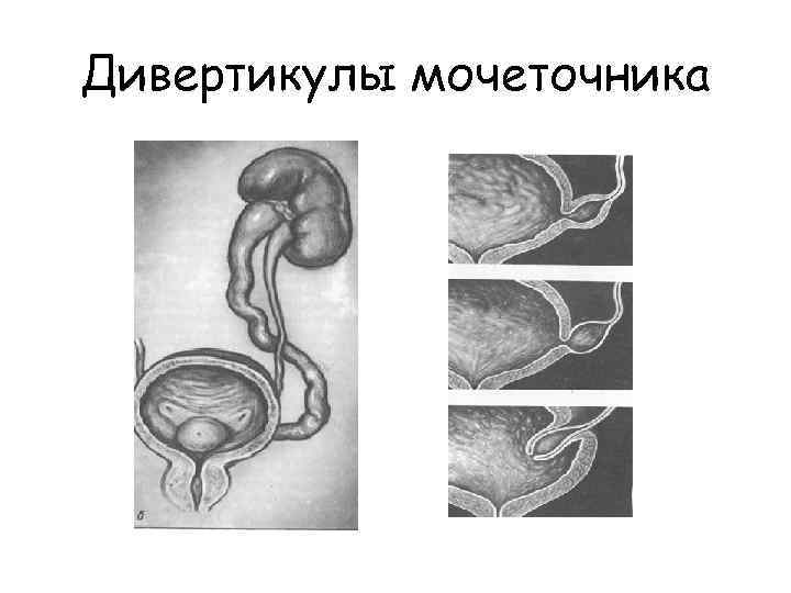 Дивертикулы мочеточника 