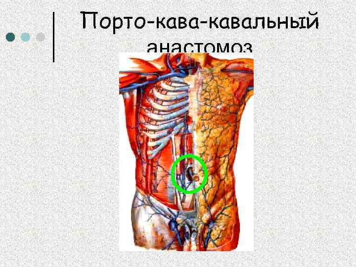 Порто-кавальный анастомоз 