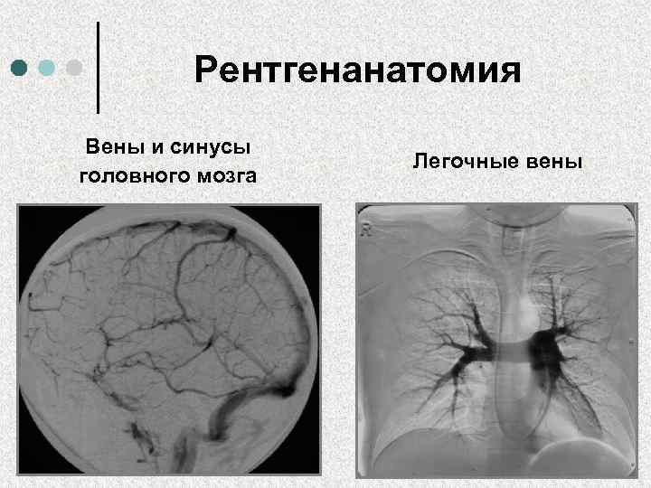 Рентгенанатомия Вены и синусы головного мозга Легочные вены 