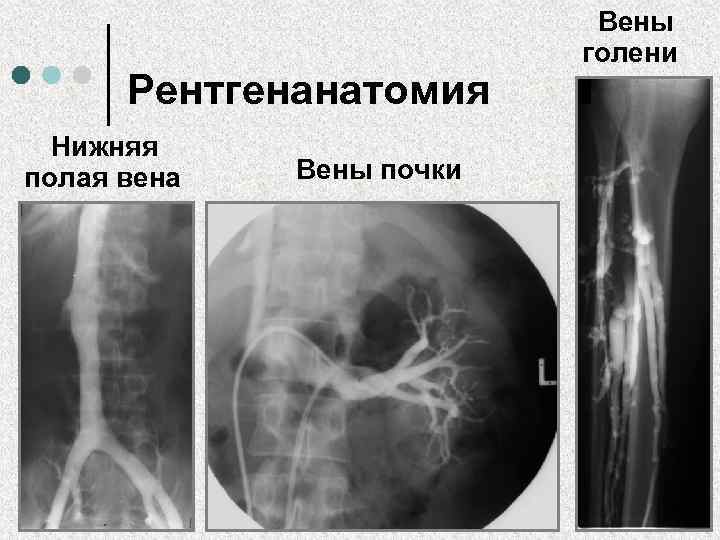 Рентгенанатомия Нижняя полая вена Вены почки Вены голени 