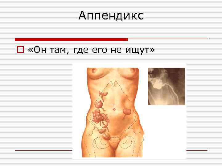 Аппендикс o «Он там, где его не ищут» 