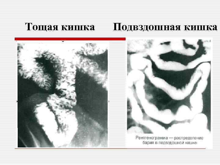 Тощая кишка Подвздошная кишка 
