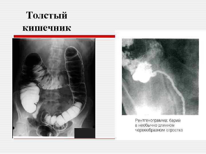 Толстый кишечник 