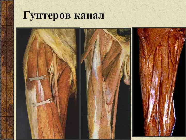 Гунтеров канал 