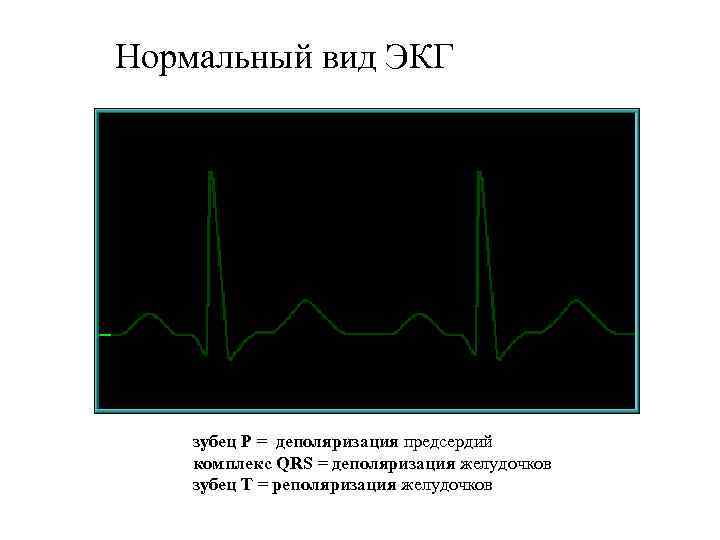 Нормальный вид ЭКГ зубец P = деполяризация предсердий комплекс QRS = деполяризация желудочков зубец