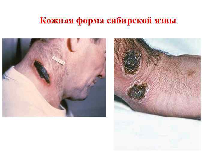 Кожная форма сибирской язвы 