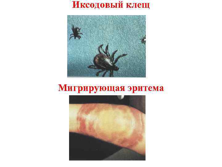 Иксодовый клещ Мигрирующая эритема 