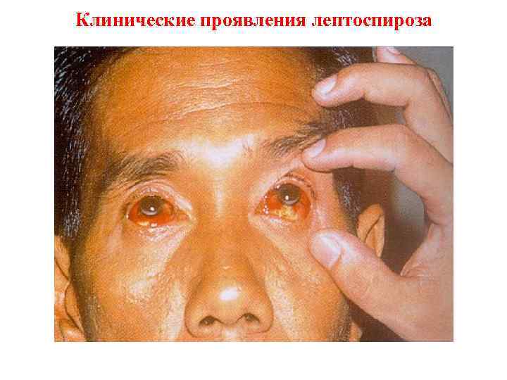 Клинические проявления лептоспироза 