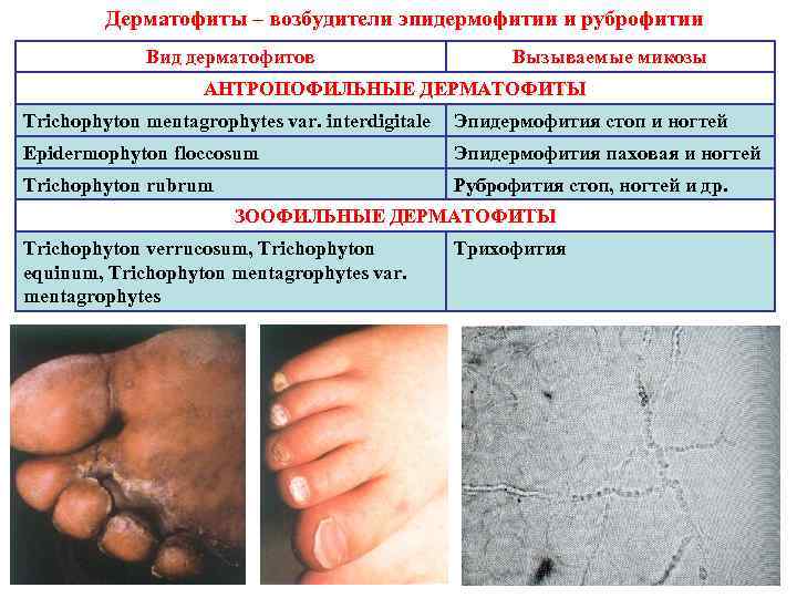 Дерматофиты – возбудители эпидермофитии и руброфитии Вид дерматофитов Вызываемые микозы АНТРОПОФИЛЬНЫЕ ДЕРМАТОФИТЫ Trichophyton mentagrophytes